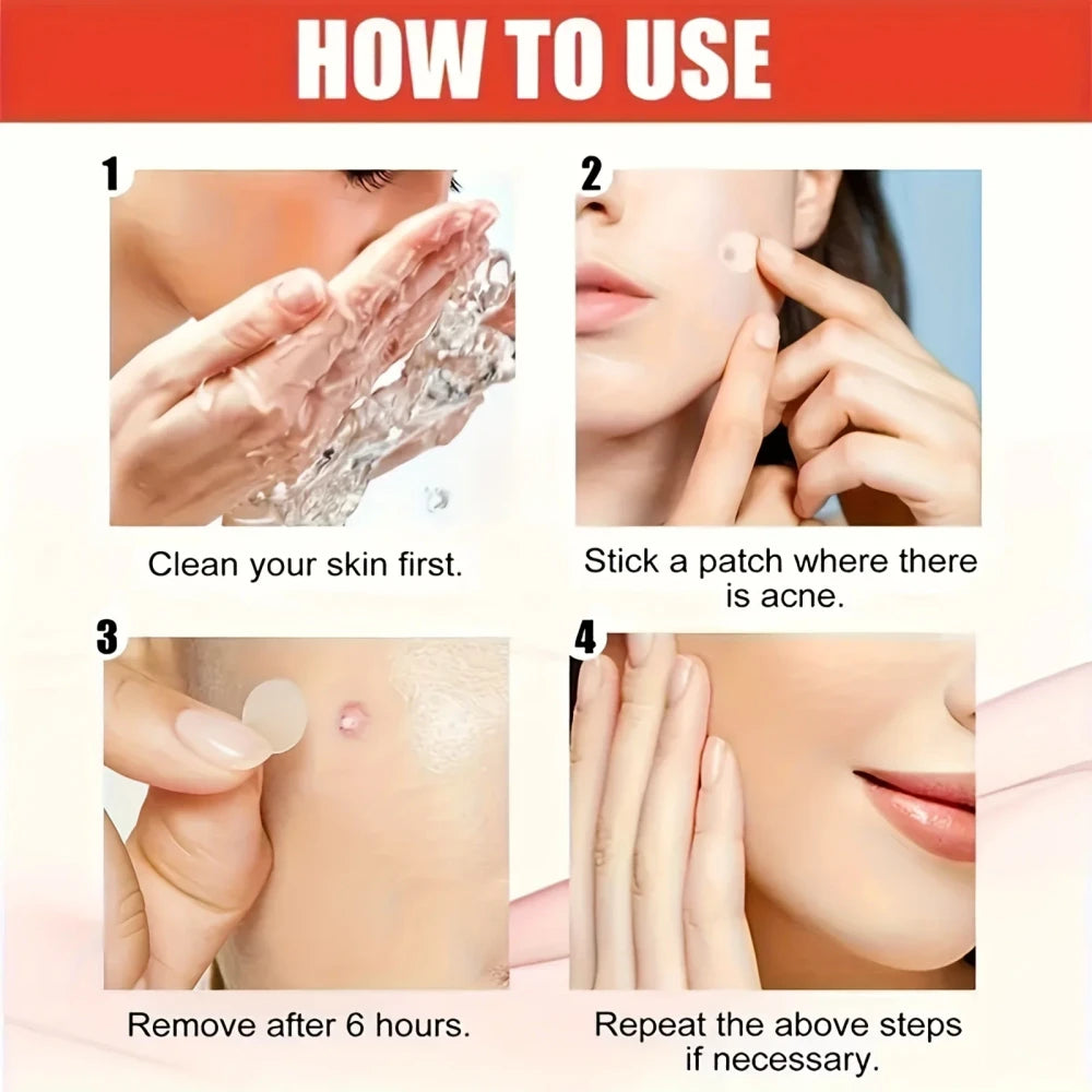 Hydrocolloid Acne Pimple Patches – Fast Blemish Care